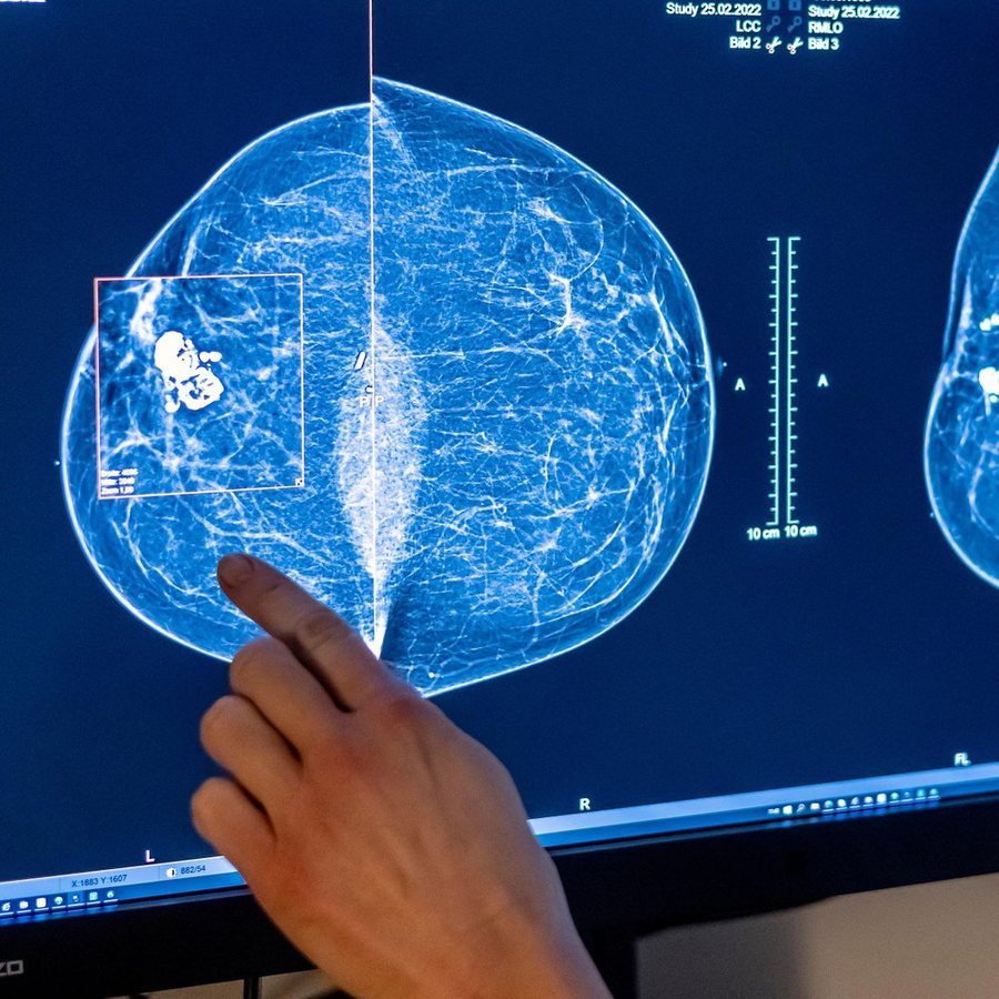 Mammografie-Screening künftig schon ab 45 Jahren